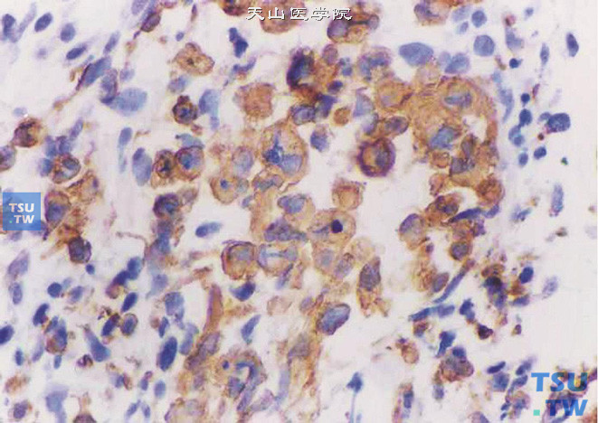 前列腺胚胎性横纹肌肉瘤，免疫组化：Desmin （+）