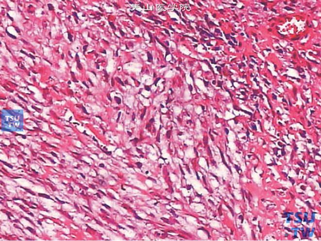 前列腺恶性纤维组织细胞瘤，瘤细胞呈梭形、多边形或类圆形
