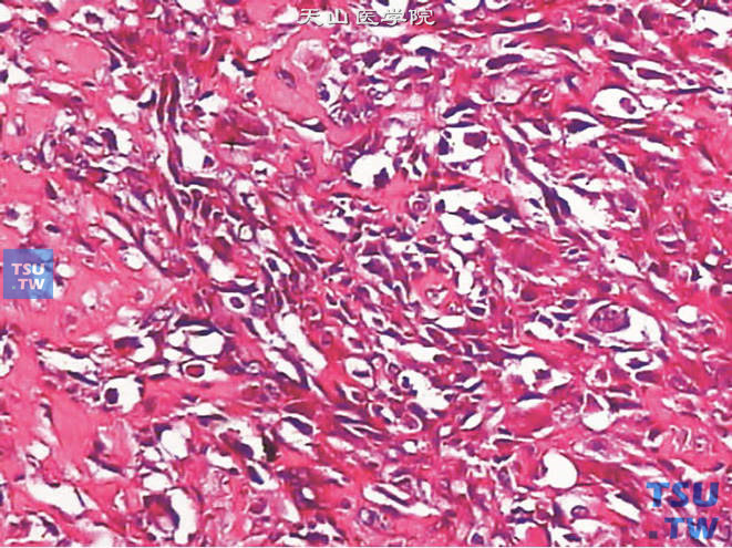 前列腺恶性纤维组织细胞瘤，上图高倍，示细胞异型性明显