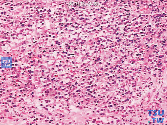 前列腺恶性B细胞性淋巴瘤。形态与发生于其他部位者类似