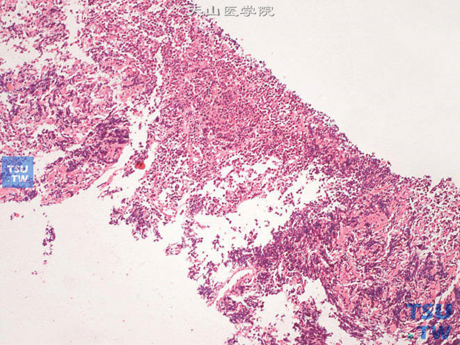 前列腺穿刺标本中的淋巴瘤，瘤细胞小，弥漫分布