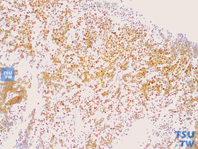 前列腺穿刺标本中的淋巴瘤，免疫组化：BCL-6 （+）