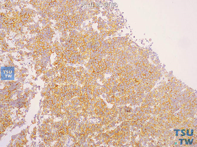 前列腺穿刺标本中的淋巴瘤，免疫组化：CD10 （+）
