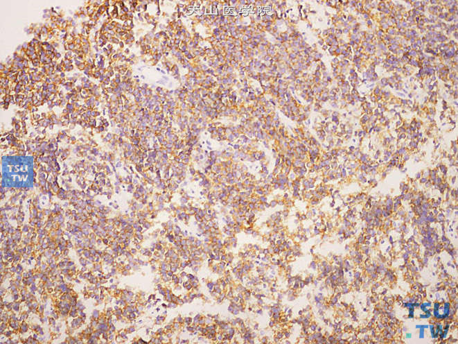 前列腺穿刺标本中的淋巴瘤，免疫组化：CD20 （+）