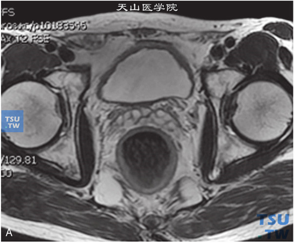 图A：CT，正常精囊腺，男，28岁，自觉排尿不畅。双侧精囊腺对称，边缘清晰，其内未见异常信号
