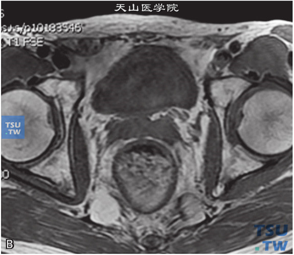 图B：CT，正常精囊腺，男，28岁，自觉排尿不畅。双侧精囊腺对称，边缘清晰，其内未见异常信号
