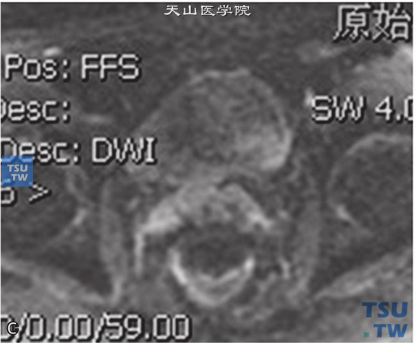 图C：CT，正常精囊腺，男，28岁，自觉排尿不畅。双侧精囊腺对称，边缘清晰，其内未见异常信号