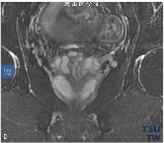 图D：CT，正常精囊腺，男，28岁，自觉排尿不畅。双侧精囊腺对称，边缘清晰，其内未见异常信号