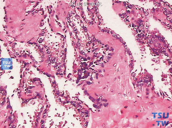 老年精囊腺。黏膜上皮细胞呈立方状，细胞可见异型性，基质可见透明变性及纤维化