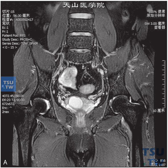 图A：CT，精囊腺囊肿伴囊内出血，男，31岁，无精子。右侧精囊腺见一囊状T2WI高信号T1WI高信号灶，边缘清晰，DWI信号稍低