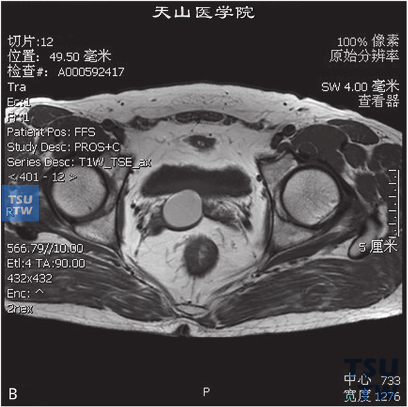 图B：CT，精囊腺囊肿伴囊内出血，男，31岁，无精子。右侧精囊腺见一囊状T2WI高信号T1WI高信号灶，边缘清晰，DWI信号稍低