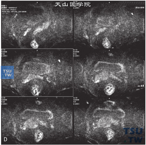 图D：CT，精囊腺囊肿伴囊内出血，男，31岁，无精子。右侧精囊腺见一囊状T2WI高信号T1WI高信号灶，边缘清晰，DWI信号稍低