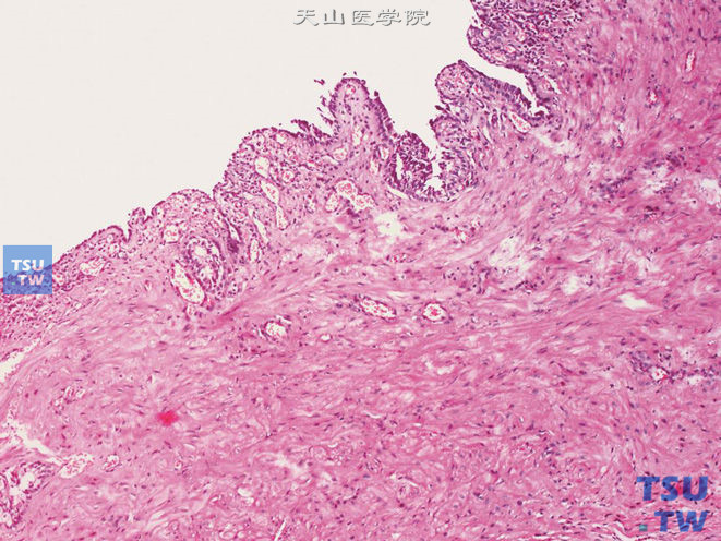 精囊腺囊肿，部分被覆上皮呈扁平状，壁层纤维化