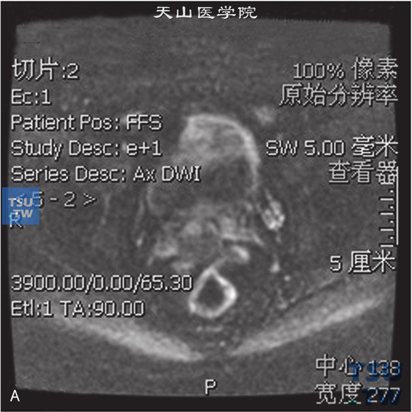 图A：CT，精囊腺占位，男，25岁，血精。右侧精囊腺基底部见一囊状T2WI低信号T1WI高信号灶，边缘清晰。囊内见一T2WI稍高T1WI低信号壁结节，DWI呈稍高信号。增强后，壁结节可见强化