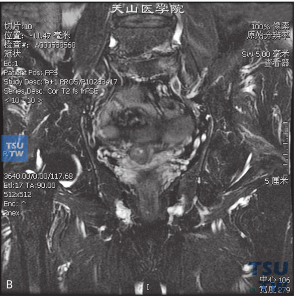 图B：CT，精囊腺占位，男，25岁，血精。右侧精囊腺基底部见一囊状T2WI低信号T1WI高信号灶，边缘清晰。囊内见一T2WI稍高T1WI低信号壁结节，DWI呈稍高信号。增强后，壁结节可见强化