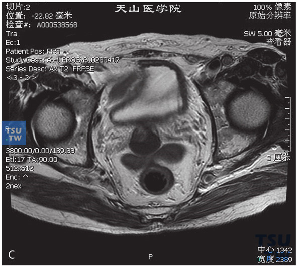 图C：CT，精囊腺占位，男，25岁，血精。右侧精囊腺基底部见一囊状T2WI低信号T1WI高信号灶，边缘清晰。囊内见一T2WI稍高T1WI低信号壁结节，DWI呈稍高信号。增强后，壁结节可见强化