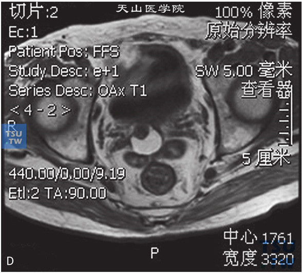 图D：CT，精囊腺占位，男，25岁，血精。右侧精囊腺基底部见一囊状T2WI低信号T1WI高信号灶，边缘清晰。囊内见一T2WI稍高T1WI低信号壁结节，DWI呈稍高信号。增强后，壁结节可见强化