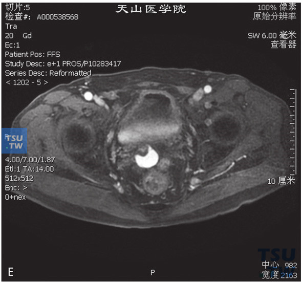 图E：CT，精囊腺占位，男，25岁，血精。右侧精囊腺基底部见一囊状T2WI低信号T1WI高信号灶，边缘清晰。囊内见一T2WI稍高T1WI低信号壁结节，DWI呈稍高信号。增强后，壁结节可见强化