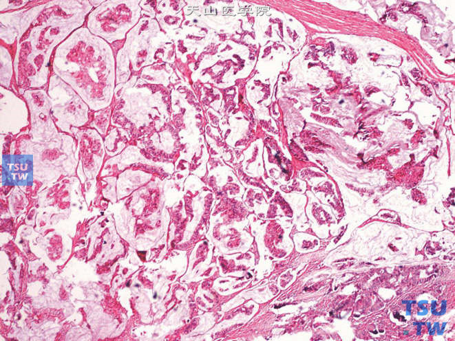 精囊腺腺癌，肿瘤组织呈乳头状结构，并具黏液性细胞分化