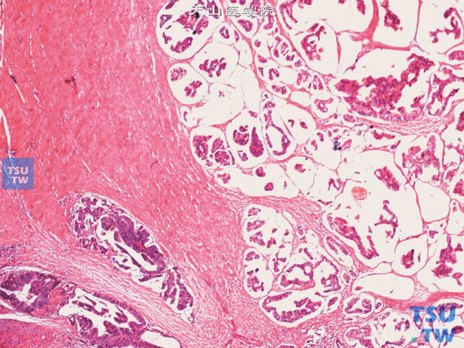 精囊腺腺癌，示肿瘤于精囊腺肌层中浸润生长