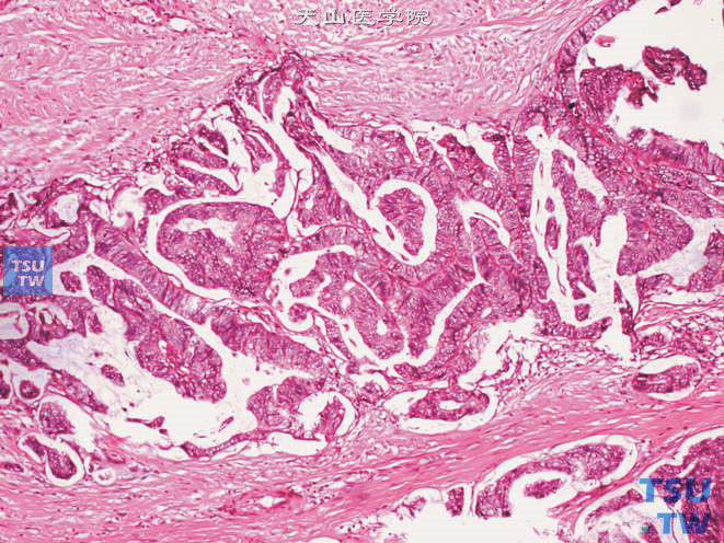 精囊腺腺癌，示乳头状结构