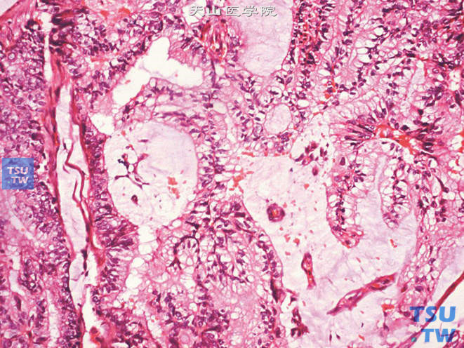 精囊腺腺癌，示部分瘤细胞胞质呈空泡状