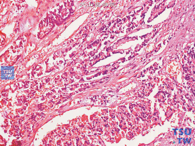精囊腺腺癌，部分区域肿瘤细胞排列成梁状或小腺腔样结构，于结缔组织中浸润性生长