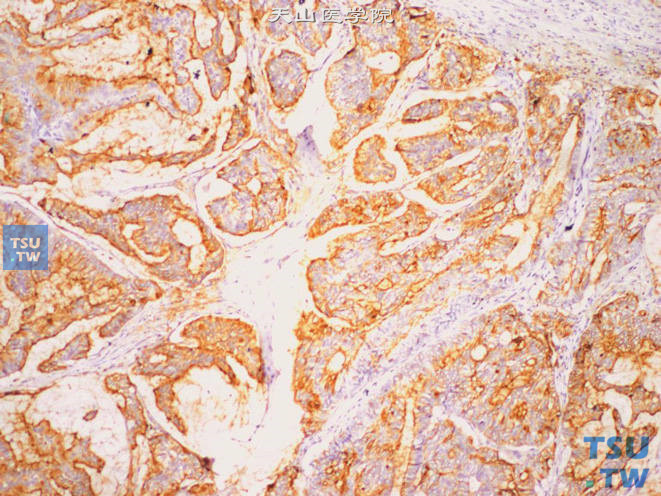 精囊腺腺癌，免疫组化：CA125（+）