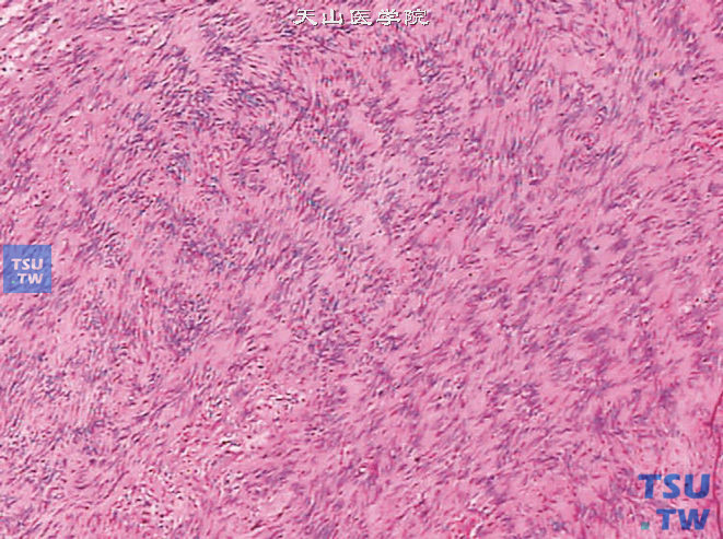 精囊神经鞘瘤，Antoni A区，细胞核密集，核排列成与细胞长轴垂直的栅栏状结构