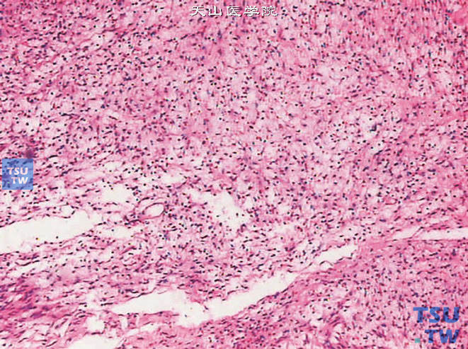 精囊神经鞘瘤，Antoni B区，示疏松网状背景，细胞成分少，核小，卵圆形