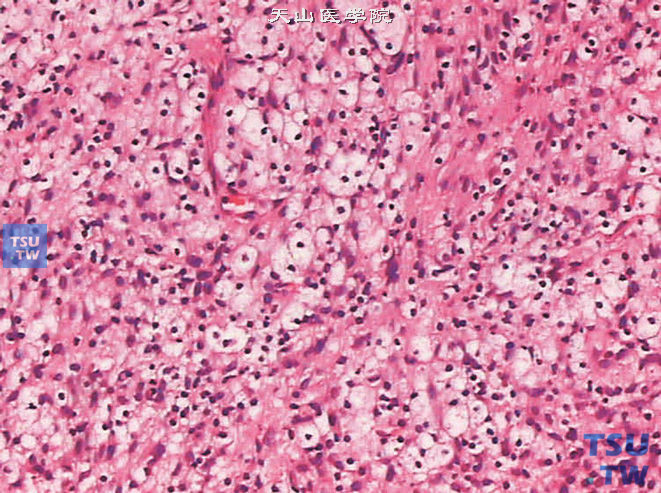 精囊神经鞘瘤，示含脂细胞聚集