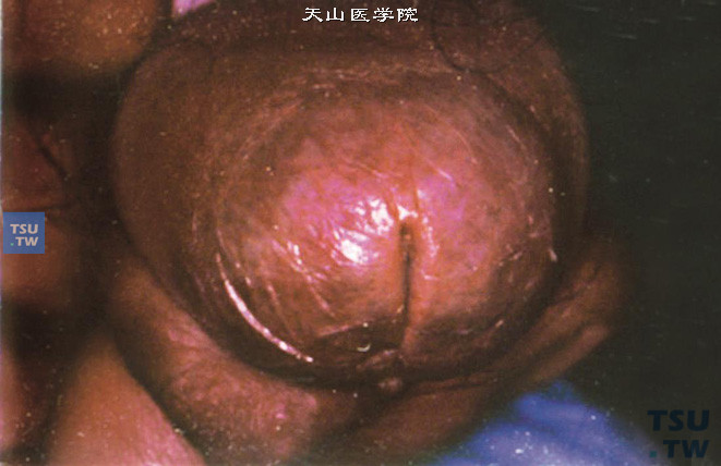 干燥性闭塞性龟头炎，龟头局限性白斑，包围尿道口，边界清楚