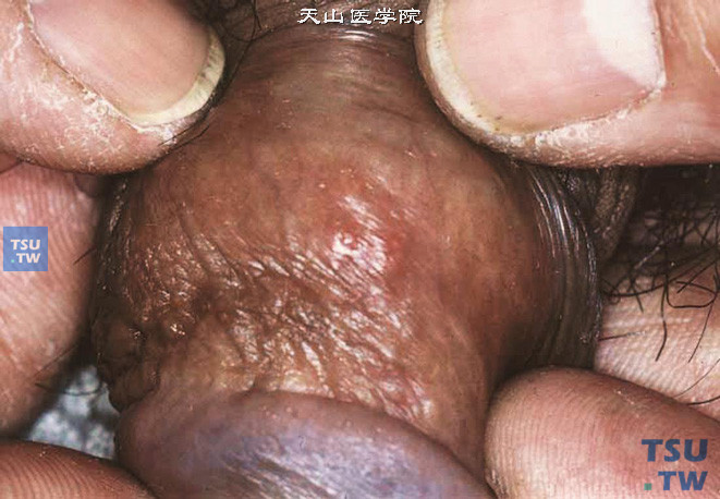 阴茎疱疹（复发性），红斑基础上的多发性水疱