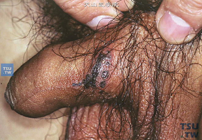 阴茎疱疹，水泡可融合、破溃，继而形成脓疱，最后结痂