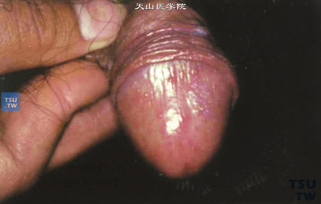 龟头念珠菌病，鲜红色炎性病损，伴多数小丘疹
