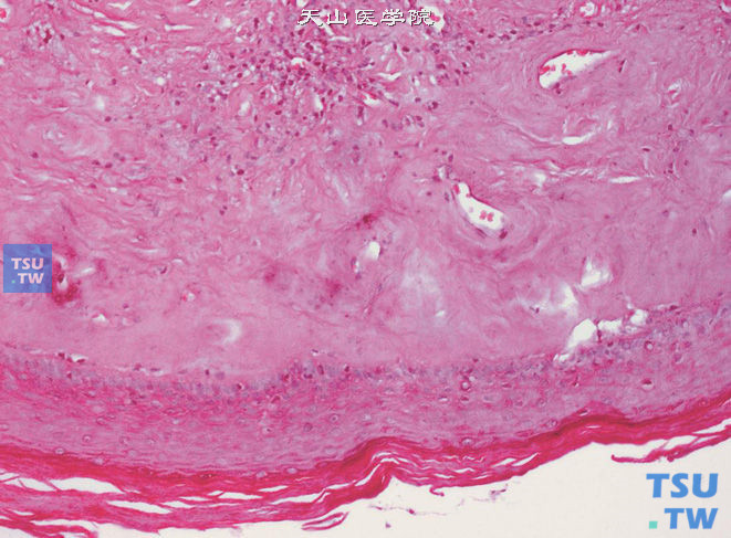 干性阻塞性龟头炎，鳞状上皮萎缩，表层角化亢进。上皮脚扁平。真皮浅层胶原纤维增生，形成均质带