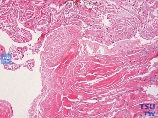 阴茎硬结（阴茎纤维性海绵体炎），可见局灶性致密的纤维组织增生结节，类似于纤维瘤病。病程较长者，纤维组织可发生玻璃样变性