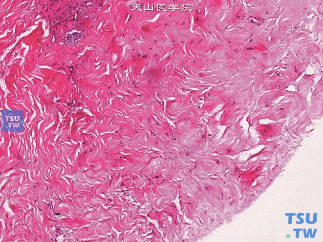 阴茎硬结，示纤维组织增生及透明变性