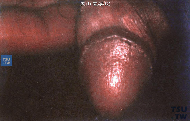 阴茎珍珠样丘疹，呈直径1～3mm的黄白色丘疹。单个病变为穹窿状，常成行排列