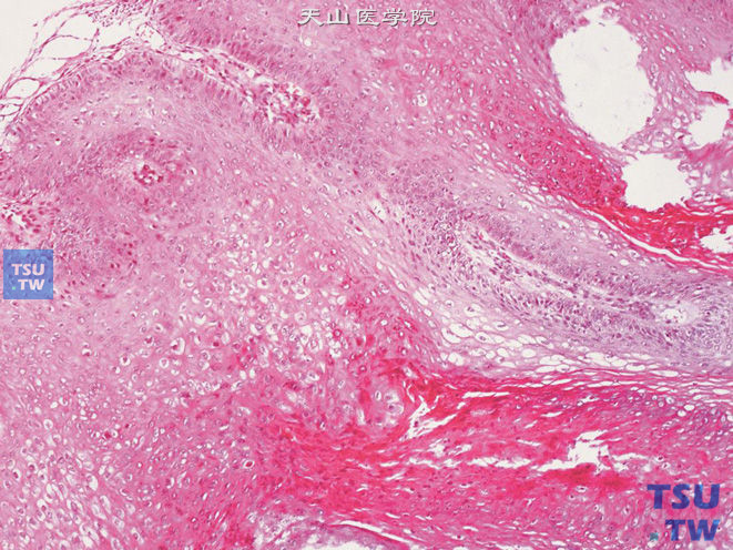 阴茎尖锐湿疣，示明显的棘层增生，乳头状瘤形成及角化过度。可见挖空细胞