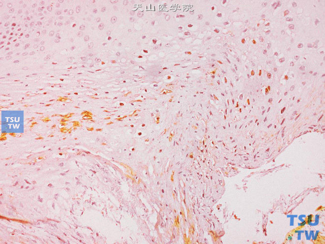 阴茎尖锐湿疣，示部分细胞核HPV（+）