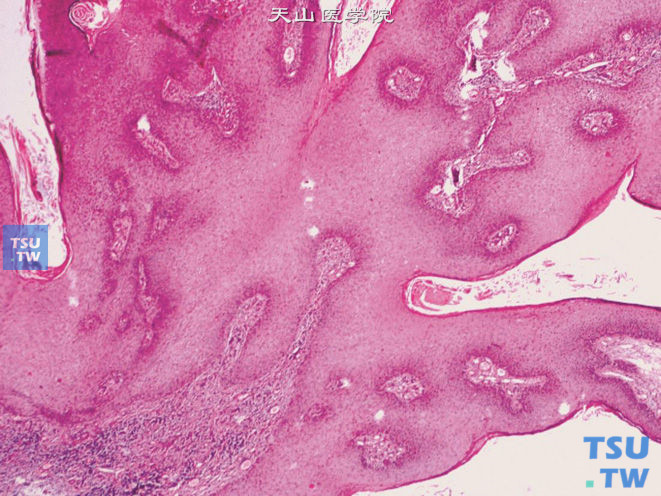 阴茎寻常疣，可见细长的乳头，上皮下大量炎细胞浸润