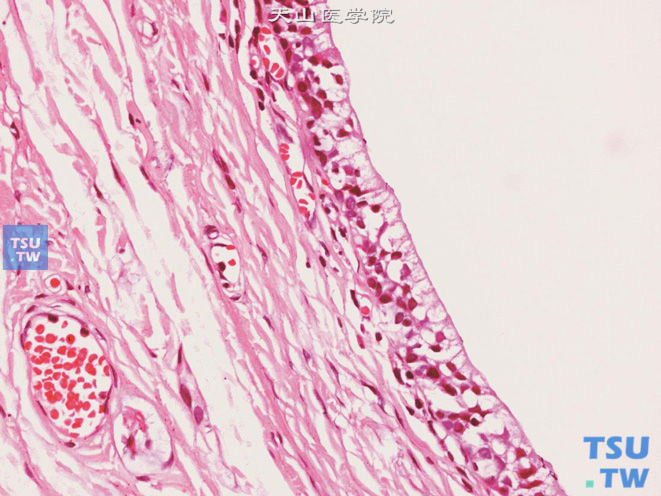 阴茎皮脂腺囊肿，示被覆上皮具皮脂腺细胞特点