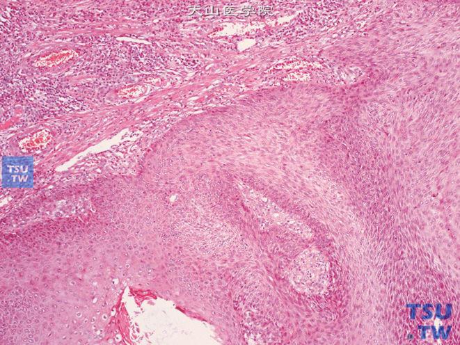 阴茎乳头状瘤，鳞状上皮呈乳头状增生，结缔组织中伴有淋巴细胞等浸润
