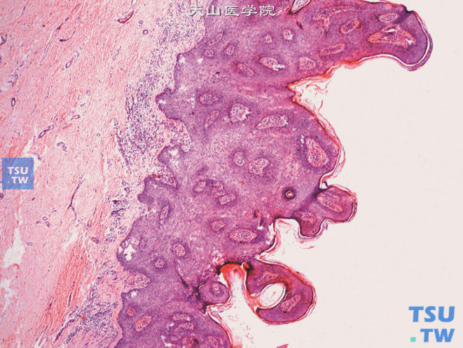 阴茎基底细胞乳头状瘤，基底细胞及棘细胞增生，伴乳头状瘤病