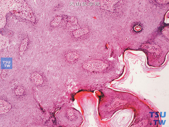 阴茎基底细胞乳头状瘤，上图高倍，示增生的基底细胞及棘细胞