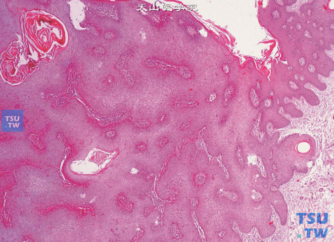 阴茎基底细胞乳头状瘤，示基底细胞增生，伴乳头状瘤样病变及角化过度，可见角质囊肿形成