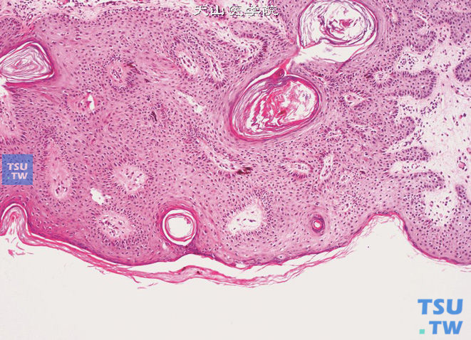 阴茎基底细胞乳头状瘤，可见基底细胞增生，呈乳头状结构，伴角化过度及角质囊肿