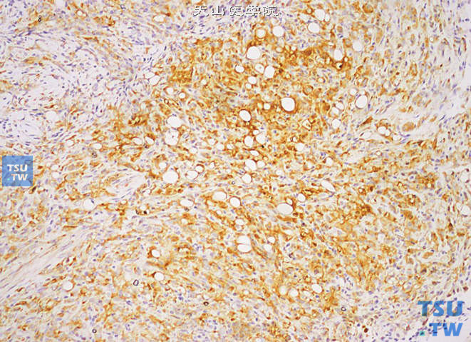 阴茎副节瘤，免疫组化：NSE（+）
