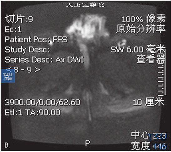 图B：阴茎癌，男，38岁，临床诊断阴茎癌。阴茎见T2WIT1WI等信号灶，DWI呈高信号，增强后明显强化，阴茎正常结构显示不清，冠状位T2WI可见双侧腹股沟多发增大淋巴结聚集成簇